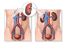 Transplante-renal