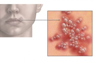 herpes