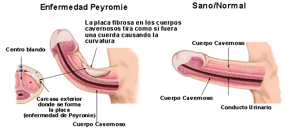 Peyronie-Enfermedad