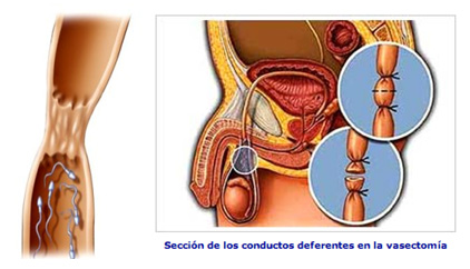 vasectomia-dr-sanchez-caba
