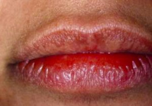 Fordyce labios